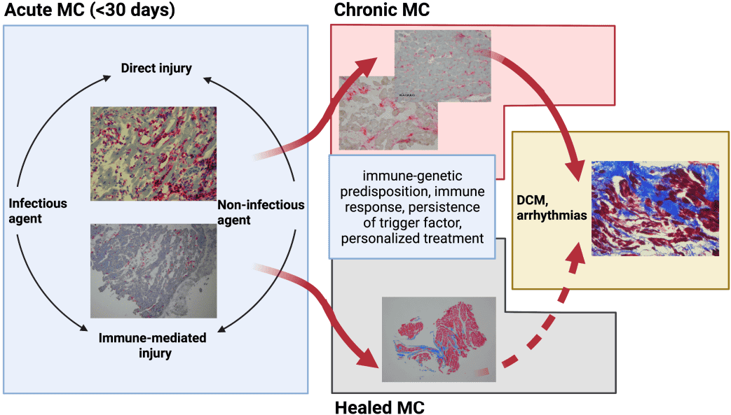 Fig.2 Myocarditis pathology. (Tymińska, et al., 2022)