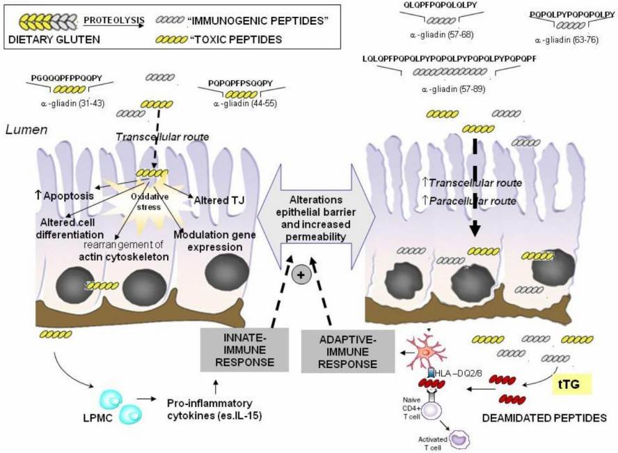 Fig.1 Intestinal epithelial damage in celiac disease. (Ferretti, et al., 2012)