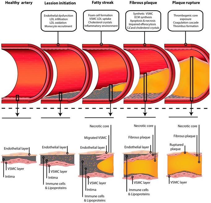 Fig.1 Schematic of atheroma plaque formation from healthy artery to rupture, highlighting key events.