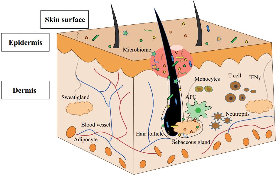 Fig.2 Skin structure and acne pathogenesis. (Yang, et al., 2022)