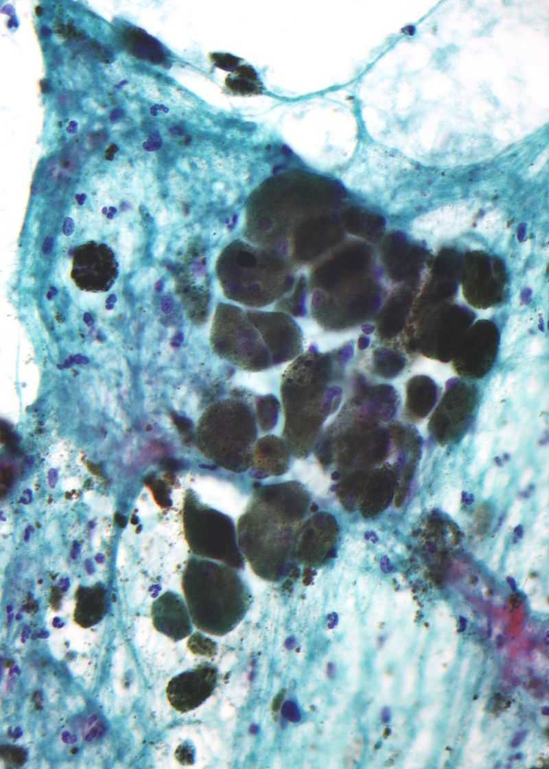 Fig.1 Melanin pigment. (From Wikipedia: By Nephron, CC BY-SA 3.0, https://en.wikipedia.org/wiki/File:Pigmented_melanoma_-_cytology.jpg)