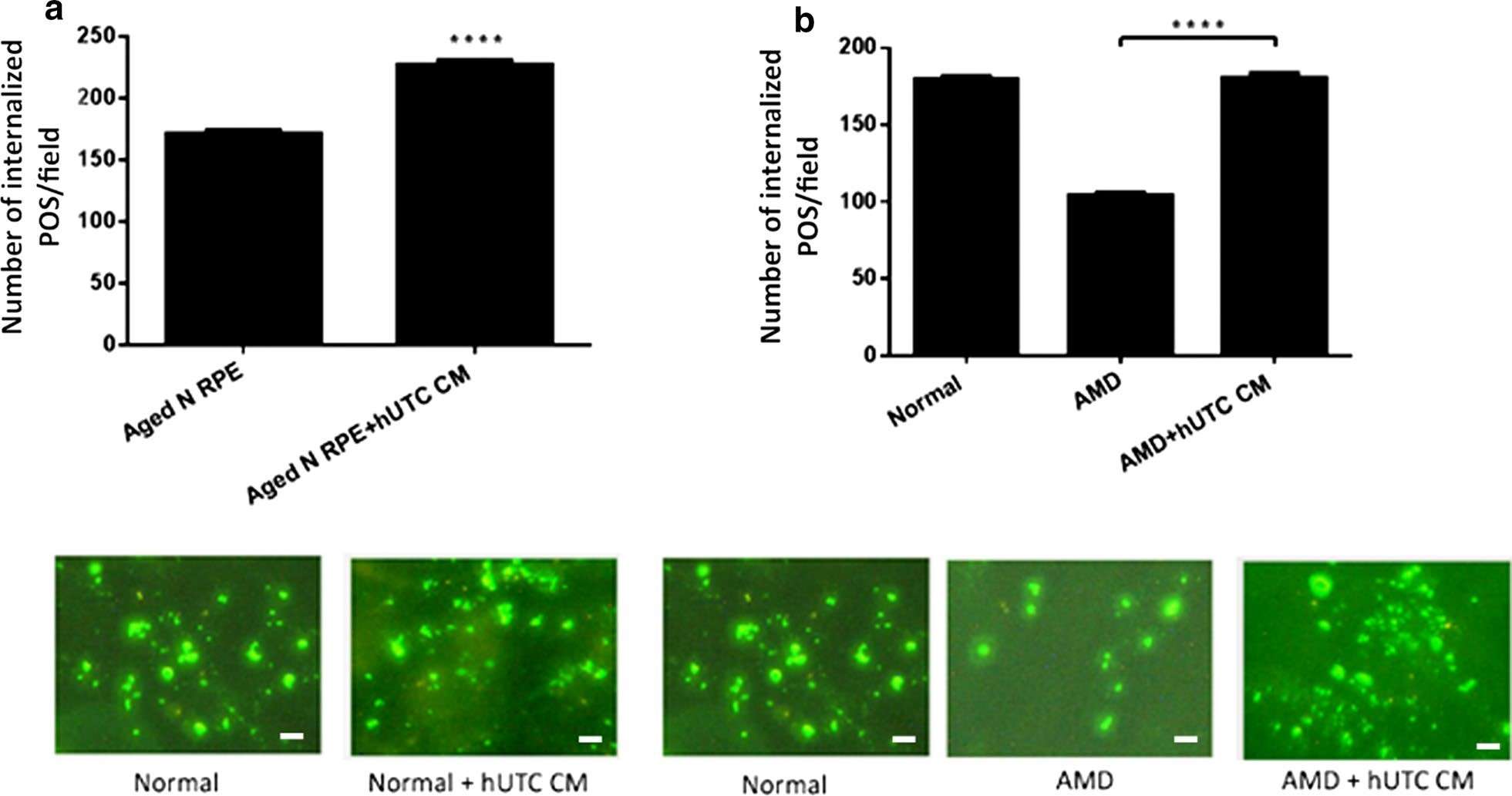 Fig.2 Impact of hUTC medium on phagocytosis in normal and AMD RPE cells. (Inana, et al, 2018)