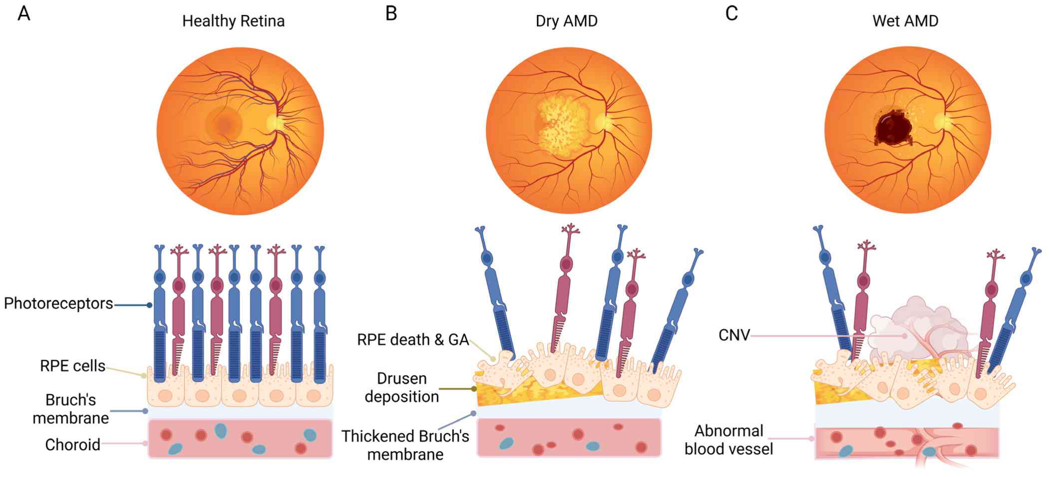 Healthy and diseased retinas. (Qu, et al., 2024)