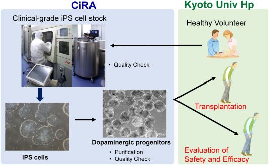 iPS cell-based therapy for Parkinson's disease. (Takahashi, Jun, 2020)