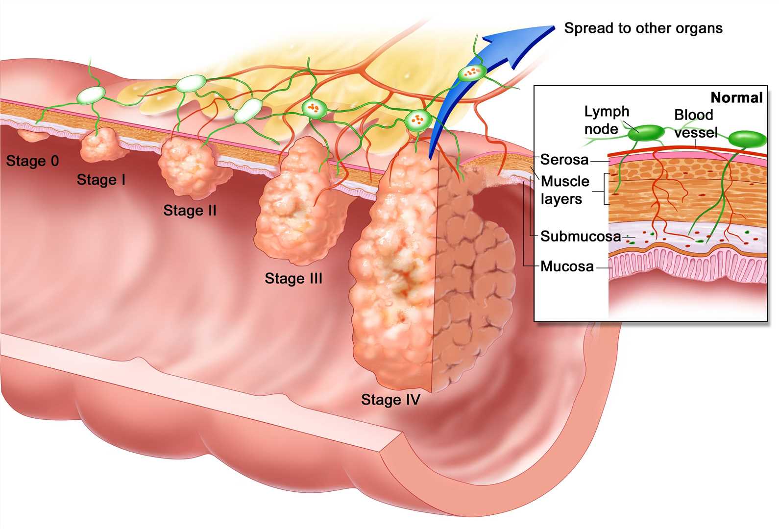 The stages of Esophageal Cancer