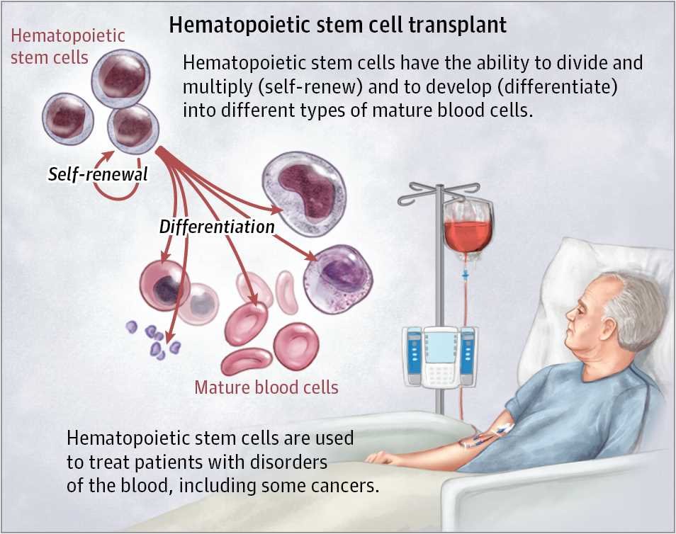 myeloma stem cell transplant