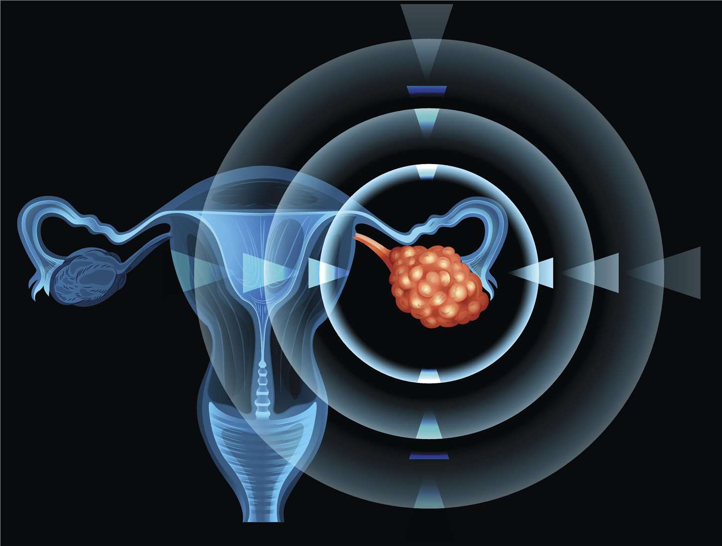 Ovarian Cancer - Creative Biolabs